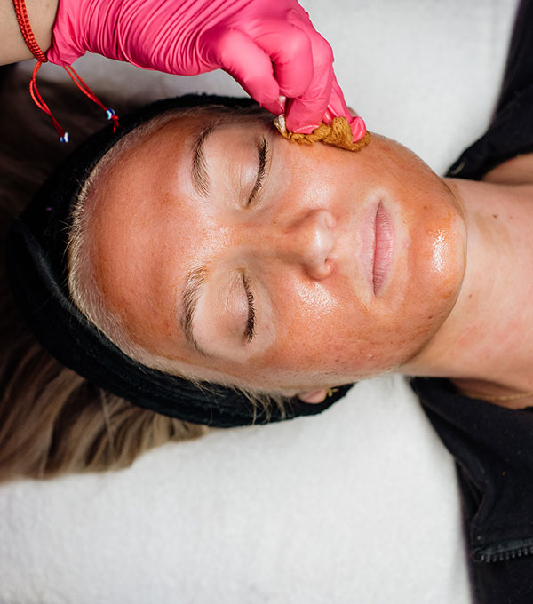 Chemical Peel